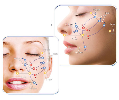 Căng da mặt bằng chỉ đang được nhiều chị em ưa thích