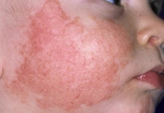 Một số điều cha mẹ cần phải biết về bệnh chàm ở trẻ nhỏ